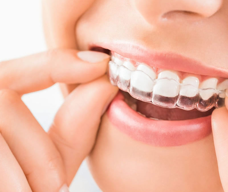 Honing In On Your Orthodontic Options: Invisalign vs. InBrace