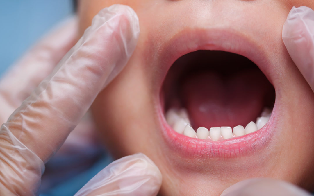 Cavities in Children Under Age Five: What You Need to Know