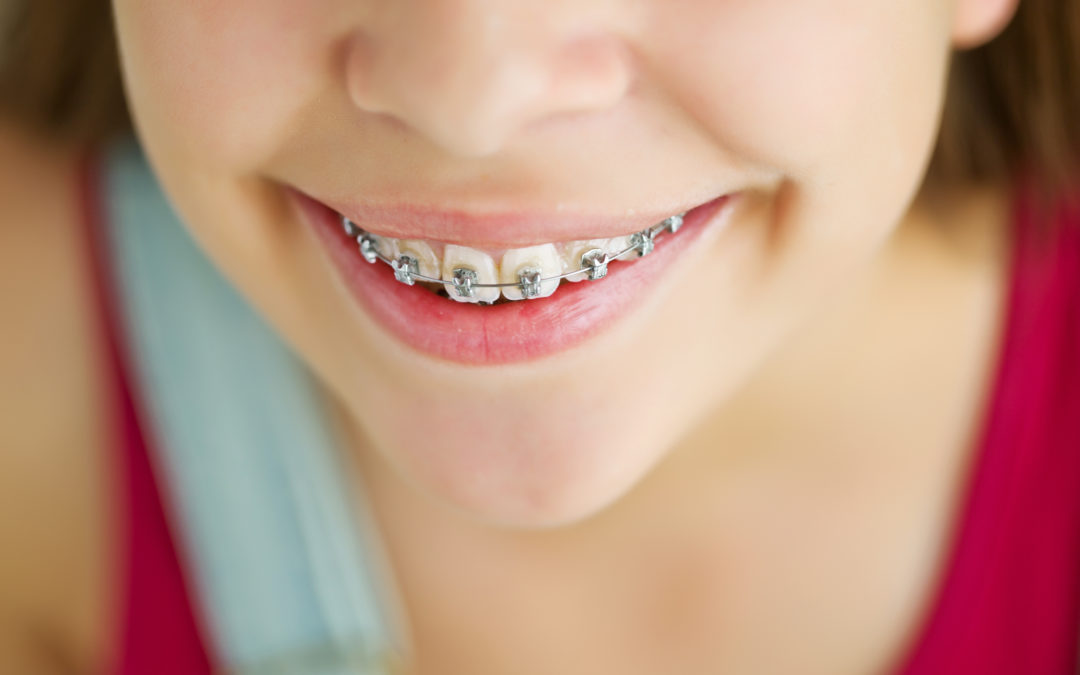 Little Tooth, A Lot of Care Part 2: How Young is Too Young for Orthodontic Care?